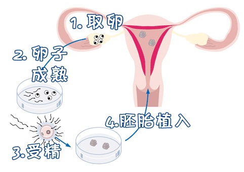安孕冻胚移植专科